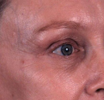 After Image: Brow Lift: Case 2 - right-front-oblique