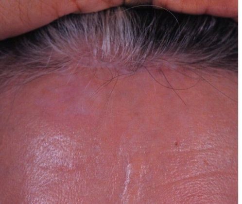 After Image: Brow Lift: Case 2 - front