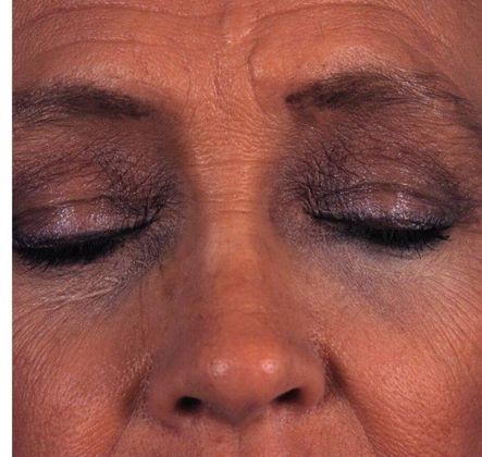 After Image: Brow Lift: Case 2 - front