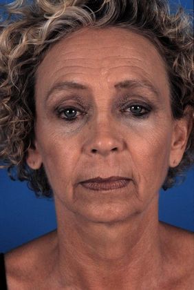 Before Image: Brow Lift: Case 2 - front