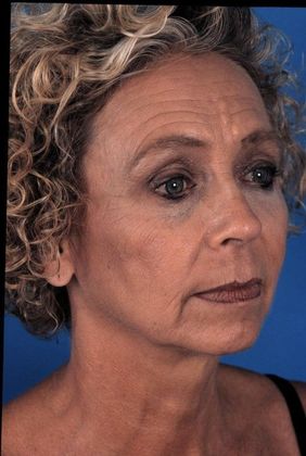 Before Image: Brow Lift: Case 2 - right-front-oblique
