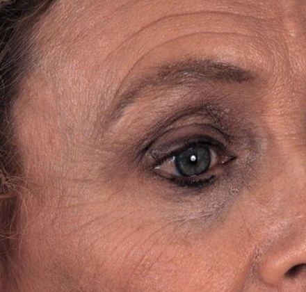 Before Image: Brow Lift: Case 2 - right-front-oblique