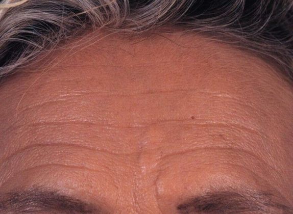 Before Image: Brow Lift: Case 2 - front