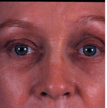 Before Image: Brow Lift: Case 2 - front