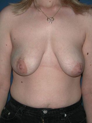 Before Image: Breast Reconstruction: Case 2 - front