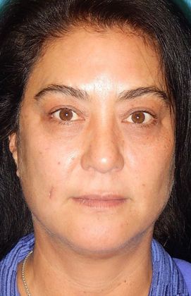 After Image: Laser Skin Resurfacing: Case 2 - front