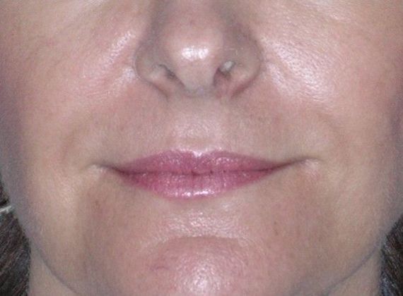 After Image: Soft Tissue Fillers: Case 2 - front