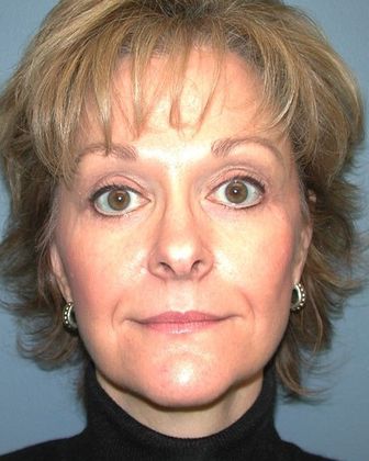Before Image: Soft Tissue Fillers: Case 2 - front