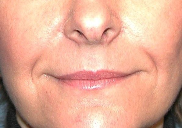 Before Image: Soft Tissue Fillers: Case 2 - front