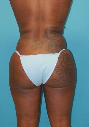 After Image: Brazilian Butt Lift: Case 2 - front