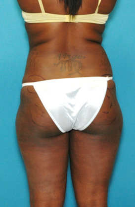 Before Image: Brazilian Butt Lift: Case 2 - front