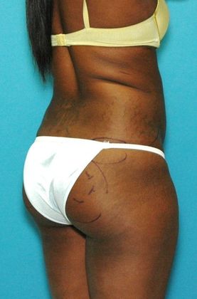 Before Image: Brazilian Butt Lift: Case 2 - right-back-oblique
