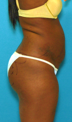 Before Image: Brazilian Butt Lift: Case 2 - right-side