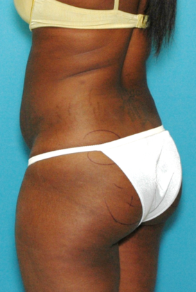 Before Image: Brazilian Butt Lift: Case 2 - left-back-oblique