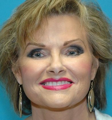 After Image: Fat Grafting Face: Case 2 - front