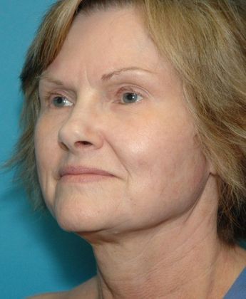 Before Image: Fat Grafting Face: Case 2 - left-front-oblique