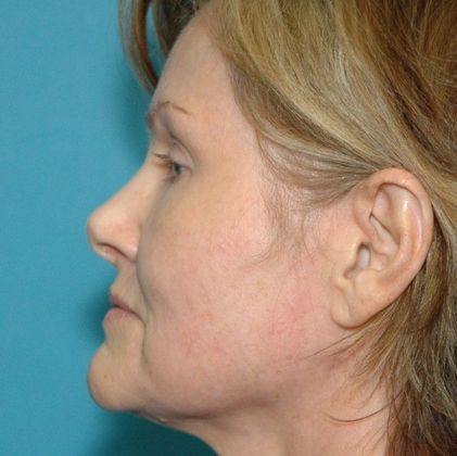 Before Image: Fat Grafting Face: Case 2 - left-side