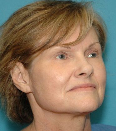 Before Image: Fat Grafting Face: Case 2 - right-front-oblique