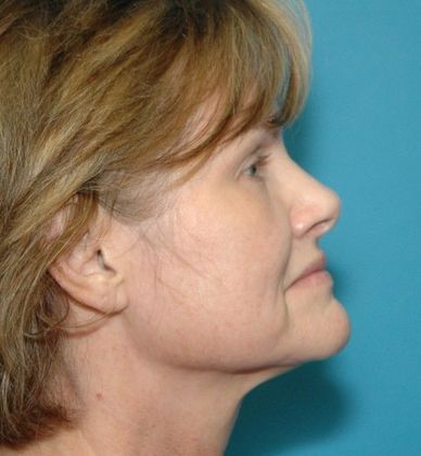 Before Image: Fat Grafting Face: Case 2 - right-side