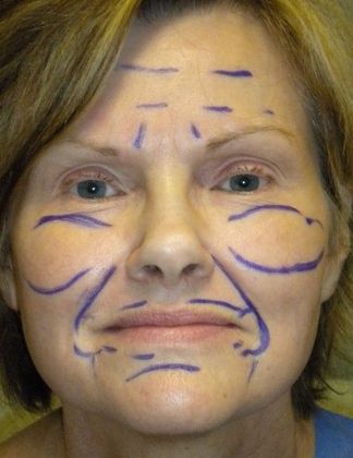 Before Image: Fat Grafting Face: Case 2 - front