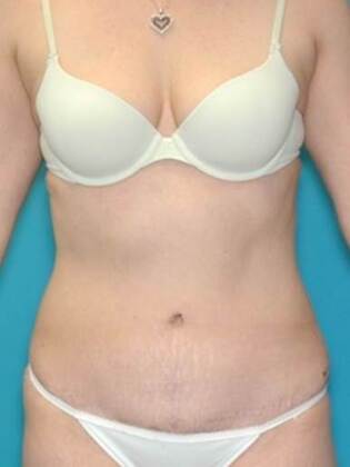 After Image: Abdominoplasty: Case 20 - front