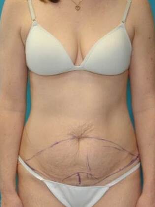 Before Image: Abdominoplasty: Case 20 - front