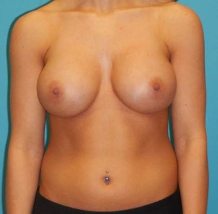 After Image: Breast Augmentation: Case 21 - front
