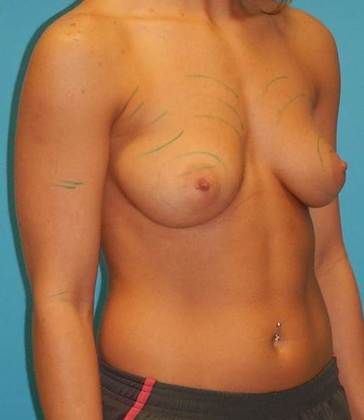 Before Image: Breast Augmentation: Case 21 - right-front-oblique