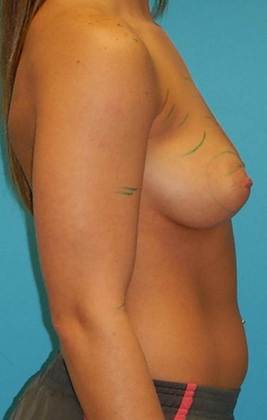 Before Image: Breast Augmentation: Case 21 - right-side
