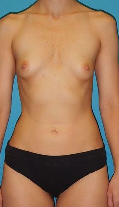 Before Image: Breast Augmentation: Case 22 - front