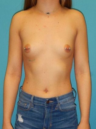 Before Image: Breast Augmentation: Case 23 - front