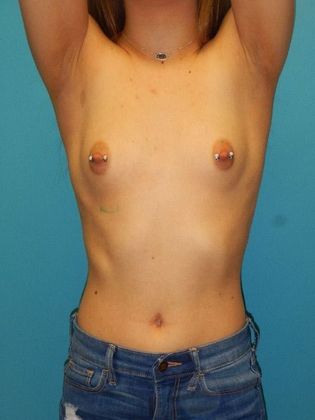 Before Image: Breast Augmentation: Case 23 - front