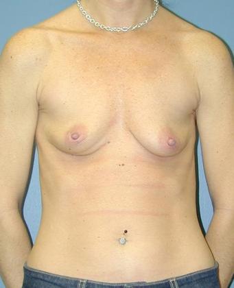 Before Image: Breast Augmentation: Case3 - front