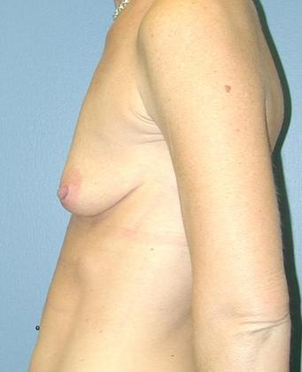 Before Image: Breast Augmentation: Case3 - left-side
