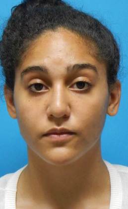 After Image: Rhinoplasty: Case 3 - front