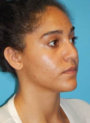 After Image: Rhinoplasty: Case 3 - right-front-oblique