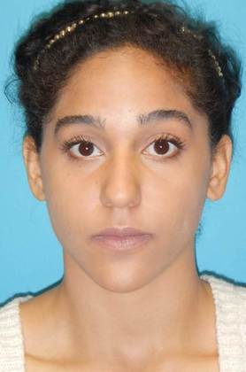 Before Image: Rhinoplasty: Case 3 - front