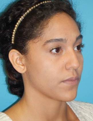 Before Image: Rhinoplasty: Case 3 - right-front-oblique