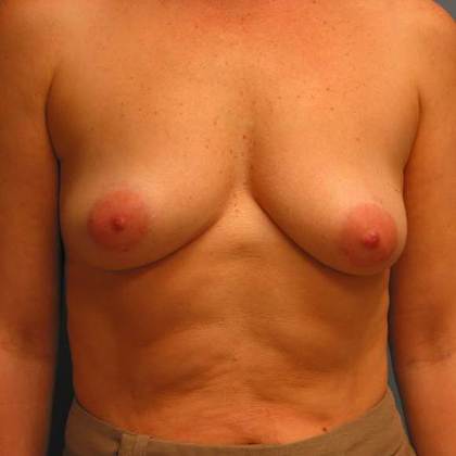 Before Image: Breast Lift Augmentation: Case 3 - front