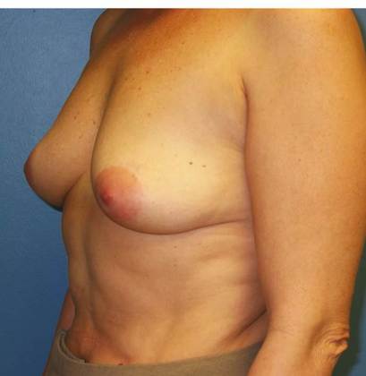 Before Image: Breast Lift Augmentation: Case 3 - left-front-oblique