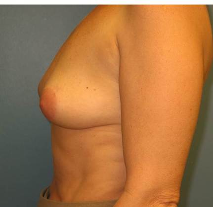 Before Image: Breast Lift Augmentation: Case 3 - left-side