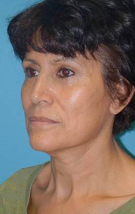 After Image: Mini Facelift: Case 3 - left-front-oblique
