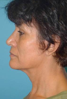 After Image: Mini Facelift: Case 3 - left-side