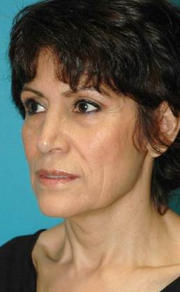 Before Image: Mini Facelift: Case 3 - left-front-oblique