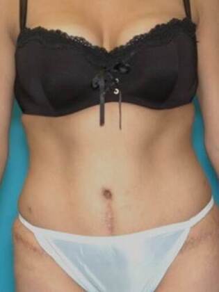 After Image: Abdominoplasty: Case 3 - front