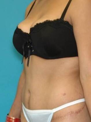 After Image: Abdominoplasty: Case 3 - left-front-oblique