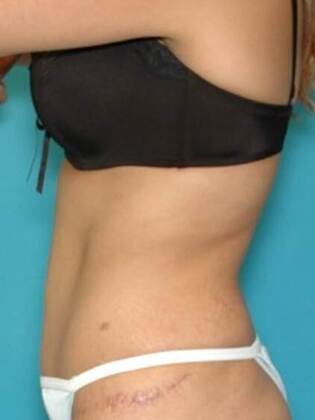 After Image: Abdominoplasty: Case 3 - left-side