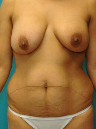 Before Image: Abdominoplasty: Case 3 - front