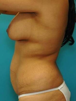 Before Image: Abdominoplasty: Case 3 - left-side