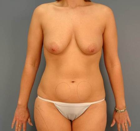 Before Image: Breast Lift: Case 3 - front